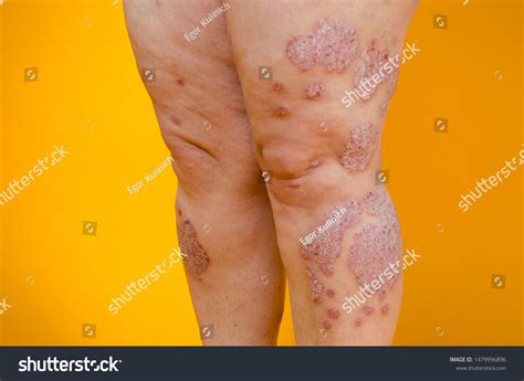 2,249 Psoriasis On Legs Images, Stock Photos & Vectors | Shutterstock
