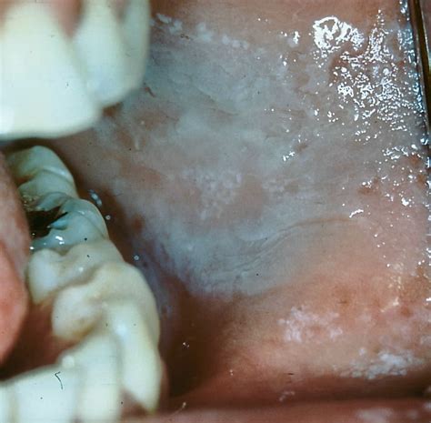 [Figure, Leukoedema present on buccal mucosa Contributed by Heather ...