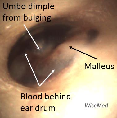Hemotympanum - January 11, 2024 - WiscMed
