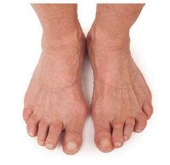 Rheumatoid Arthritis Foot Treatment | Los Angeles Foot Doctor