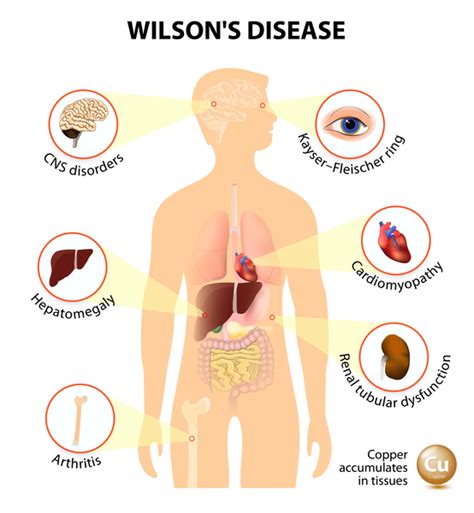 Detailed Description of Wilson Disease by Dr Arun Aggarwal ...