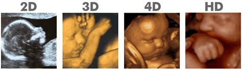 3D ultrasound Atlanta, 4D ultrasound, HD Ultrasound Atlanta, GA