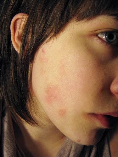 pimples all around eczema | WHYYYYYYYYY?!?!, howww can it be… | Flickr