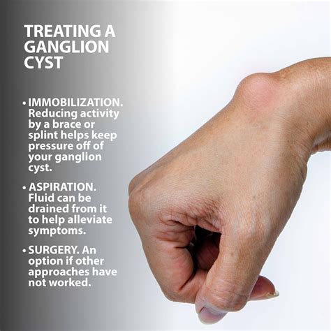 Ganglion Cyst Causes Management Of Painful Ganglion C - vrogue.co