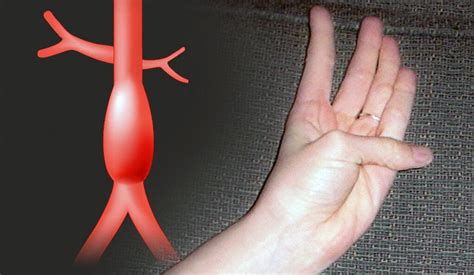 All in favor of a test for aortic aneurysms, raise your hand | YaleNews