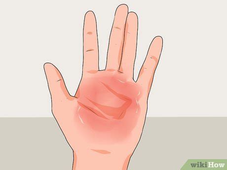 4 Ways to Treat a Hand Burn - wikiHow