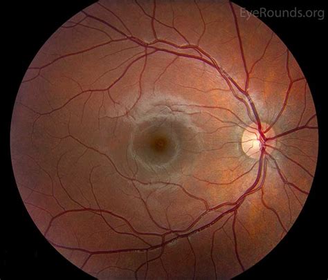 Atlas Entry - Normal fundus - adult