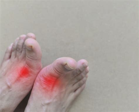 7 Supplements for Gout Flare Up - Healthy Supplements Guide