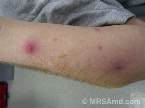 Mrsa Skin Lesions