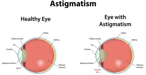 Is astigmatism more common among rh(D) negative persons? – The Rh ...