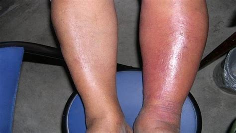 28 Natural Home Remedies For Cellulitis In Children & Adults | Foot remedies, Cellulitis ...