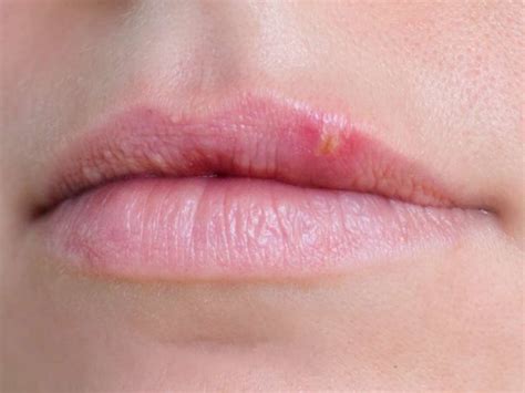 Herpes On Lips Symptoms Offer Store, Save 70% | jlcatj.gob.mx