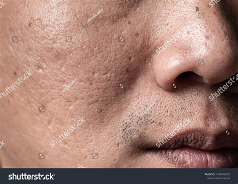 Asian Man Faceskin Problem Acne Hole Stock Photo 1798490575 | Shutterstock