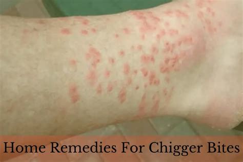 How To Get Rid Of Chigger Bites - Jan 21, 2020 · you can also get relief if you take ...