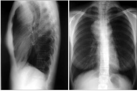 Chest X-ray revealed an expansive anterior mediastinal mass. | Download ...