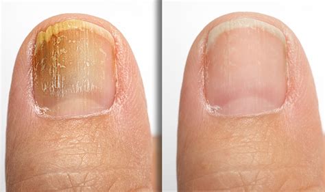 Discover more than 133 mycotic nails definition super hot - ceg.edu.vn