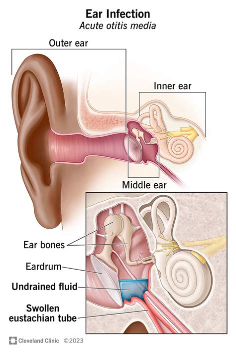 Ear Infection (Otitis Media): Symptoms, Causes Treatment, 57% OFF