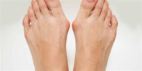 What Does Bunion Pain Feel Like? - Foot And Ankle