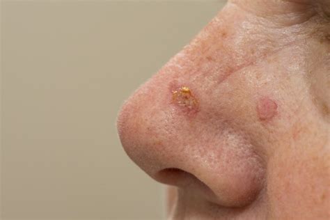 Actinic Keratosis Treatment | Basko Dermatology | Naperville Dermatologist