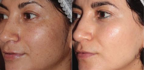 BBL® Laser Skin Rejuvenation Before and After Pictures Case 251 ...