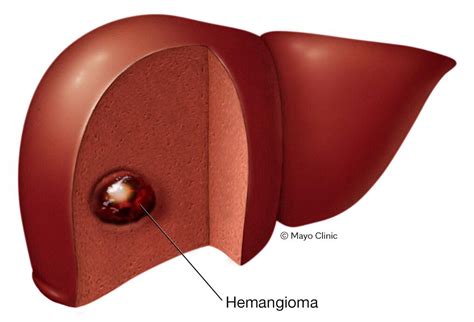 Hemangioma hepático - Síntomas y causas - Mayo Clinic