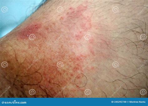 Itchy Rash in the Groin Area. Tinea Cruris is a Type of Skin Disease that Occurs in the Groin ...