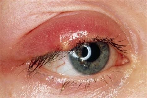 Orzaiolo: un'infiammazione dell'occhio che colpisce grandi e piccini