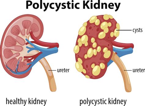 The kidney disease that's going unnoticed | The New Daily