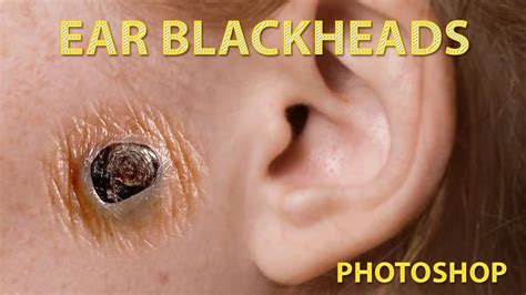 Infected Blackhead In Ear