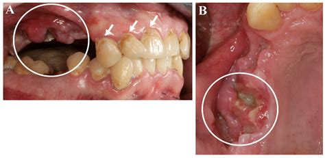 Teeth Of Methamphetamine Use Before And After