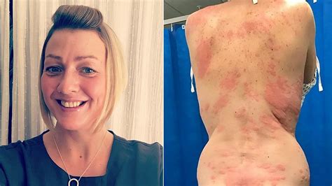 Woman claims allergic reaction to vape caused painful rash, required ...