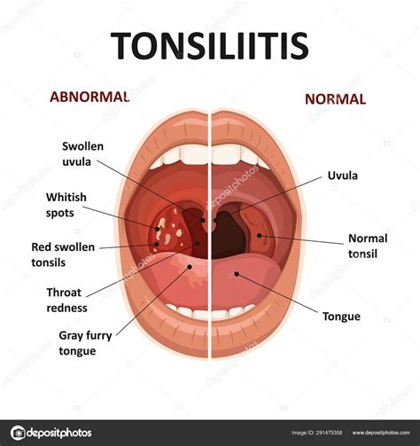 Tonsils and throat diseases. Tonsillitis symptoms. Anatomy of human mouth. Stock Vector Image by ...