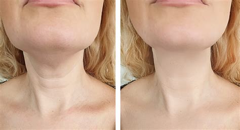 Amazing Non-Surgical Neck Lift Before and After Results - St Louis Lipo