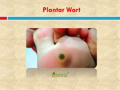 PPT - Plantar Wart: Causes, Symptoms, Daignosis, Prevention and Treatment PowerPoint ...