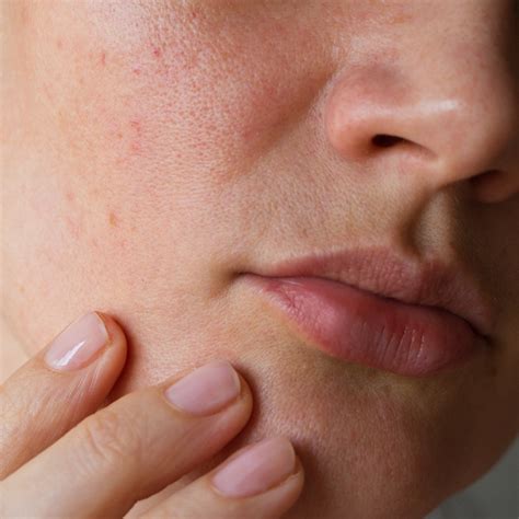 This is the Best Treatment for Keratosis Pilaris, According to a Dermatologist - SHEfinds