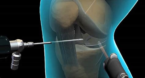 Arthroplasty: Procedure, Risks and Recovery | Dr. Ramakant Kumar