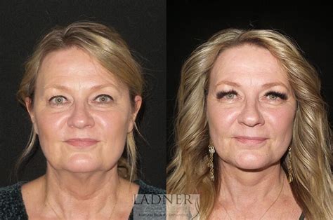 Facelift / Neck Lift Before and After Pictures Case 31 | Denver, CO ...