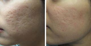 Microdermabrasion for Acne Scars | Dr Chen Tai Ho