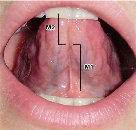 [PDF] Clinical analysis of proposed classification of the lingual frenulum by index and ...