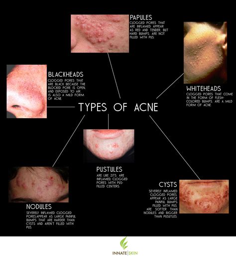 How to Recognize What Kind of Acne You Have | Innate Skin | Types of ...