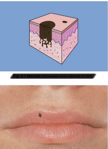 Intro to Preliminary Diagnosis of Oral Lesions Flashcards | Quizlet