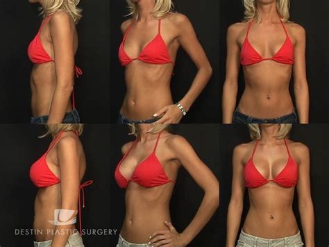 Breast augmentation through the underarm, under the muscle by Dr Scott ...