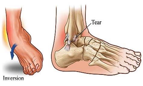 A Guide to Ankle Sprains | Hurst Podiatry