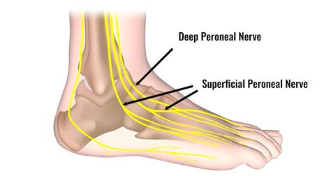 Peroneal Nerve Injury - Symptoms, Causes, Treatment & Exercises