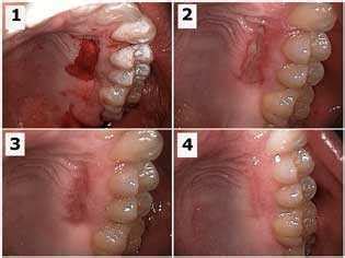 Wound healing after oral surgery and periodontal surgery