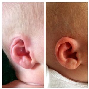 Ear Molding for Newborn Babies With Ear Deformities - Washington Parent