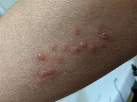 is this spider bite, should I go to Doctors...4 days old : r/spiderbites