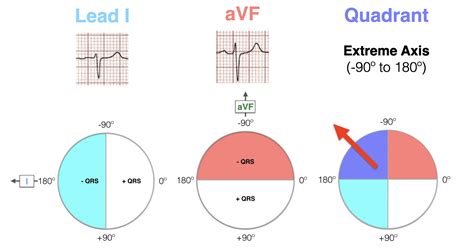 ECG Axis Interpretation • LITFL • ECG Library Basics