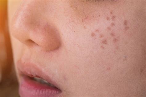 Freckles Bikin Kurang Percaya Diri? Hilangkan dengan Cara Ini - Alodokter