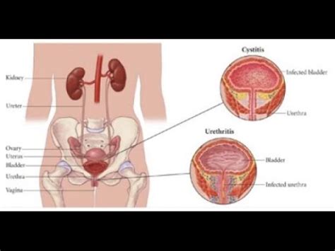 Symptoms of Bladder Infection in Women - YouTube